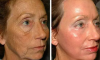 2 лесни начини за премахване на бръчки по лицето у дома, без операция и без козметик