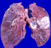Рак на белия дроб: как да не пропуснете началото на заболяването?