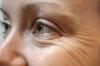 Как да се предотврати появата на бръчки около очите