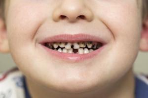 Как да спрем кариеса в млечните зъби - стоматологични съвети