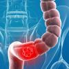 Рак на дебелото черво: 5 признаци, че ще ви помогне да не го бъркайте с хемороиди