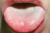 Какво прави бели плаки по езика?