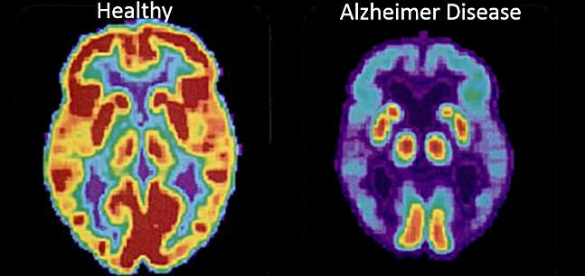 Първото изображение - мозъка на здрав човек, а вторият - болестта на Алцхаймер 