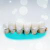 Популярни шиниране на зъбите: колко ефективно?