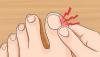 Как да се отървем от гъбички на ноктите в домашни условия