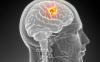 Симптомите на начален мозъчен тумор