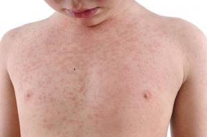 Алергия към слънцето в едно дете: причини, симптоми и лечение
