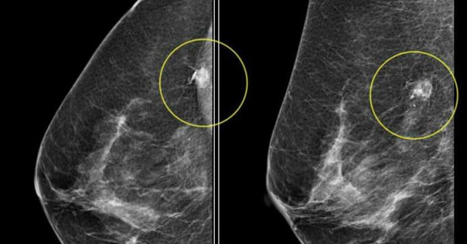 рак на гърдата - рак на гърдата