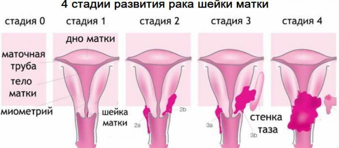 4 етапа на рак на маточната шийка
