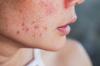Как да подредите кожата си след лятото: домашни и салонни процедури