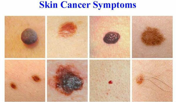 Симптомите на рак на кожата