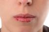 5 съвета за това как да се предотврати напукване на устните